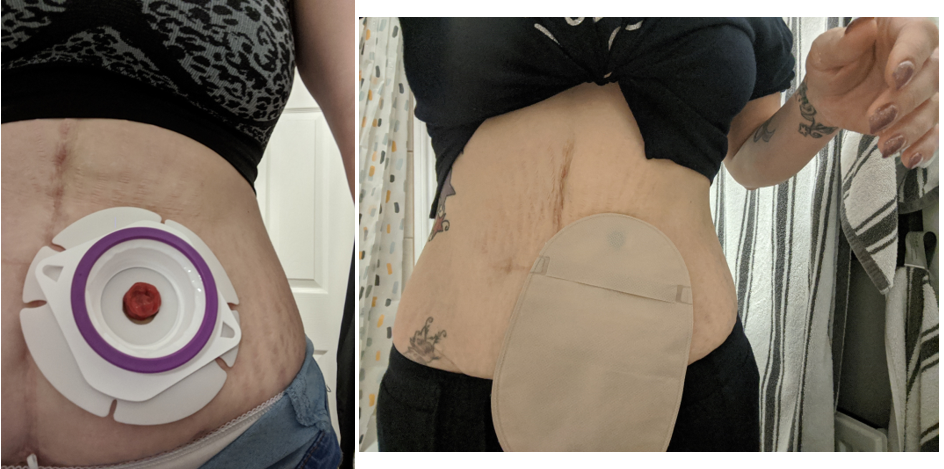 Urostomy Bag vs. Colostomy Bag: What's the Difference?
