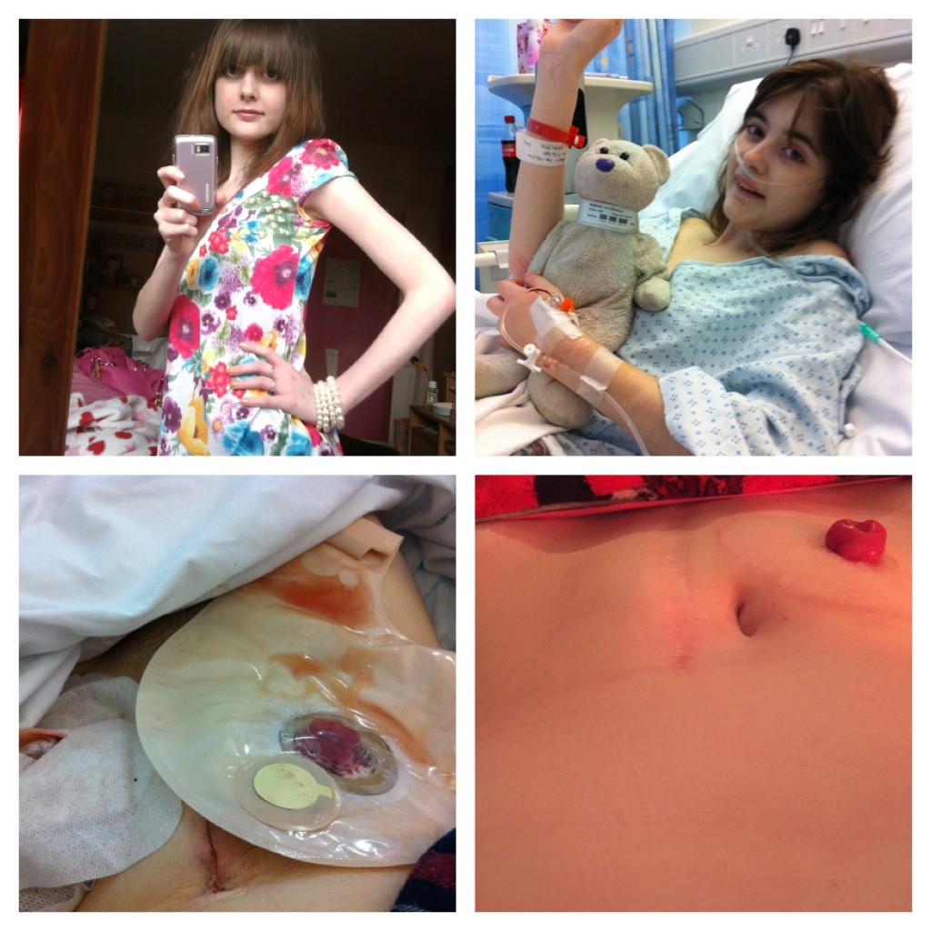 Ileostomy - discharge Information | Mount Sinai - New York